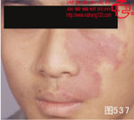 血管瘤病理图片图521-图540(图17)