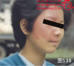 血管瘤病理图片图521-图540(图18)