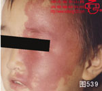血管瘤病理图片图521-图540(图19)