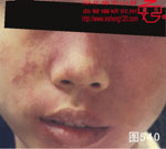 血管瘤病理图片图521-图540(图20)