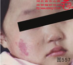 血管瘤病理图片图541-图560(图16)