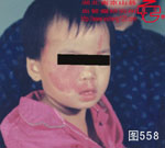 血管瘤病理图片图541-图560(图17)