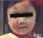 血管瘤病理图片图561-图580(图1)