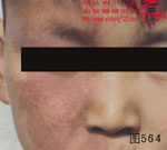 血管瘤病理图片图561-图580(图3)