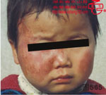 血管瘤病理图片图561-图580(图2)