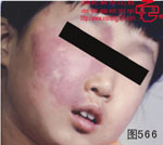 血管瘤病理图片图561-图580(图5)