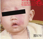 血管瘤病理图片图561-图580(图9)