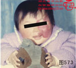 血管瘤病理图片图561-图580(图12)
