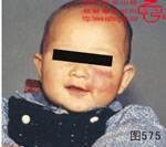 血管瘤病理图片图561-图580(图14)