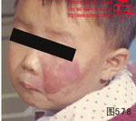 血管瘤病理图片图561-图580(图17)