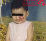 血管瘤病理图片图581-图600(图3)