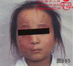 血管瘤病理图片图581-图600(图2)