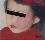 血管瘤病理图片图581-图600(图5)