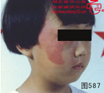 血管瘤病理图片图581-图600(图6)