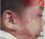 血管瘤病理图片图581-图600(图7)