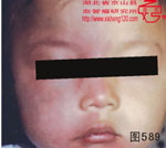 血管瘤病理图片图581-图600(图8)
