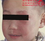 血管瘤病理图片图581-图600(图9)
