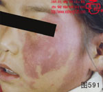 血管瘤病理图片图581-图600(图10)