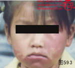 血管瘤病理图片图581-图600(图12)