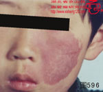血管瘤病理图片图581-图600(图11)