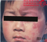 血管瘤病理图片图581-图600(图17)