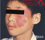 血管瘤病理图片图581-图600(图19)