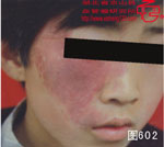 血管瘤病理图片图601-图620(图1)