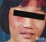 血管瘤病理图片图601-图620(图3)