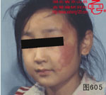 血管瘤病理图片图601-图620(图2)