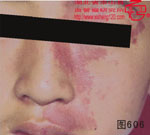 血管瘤病理图片图601-图620(图5)