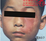血管瘤病理图片图601-图620(图6)
