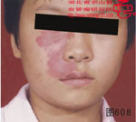 血管瘤病理图片图601-图620(图7)