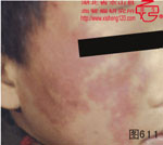 血管瘤病理图片图601-图620(图10)