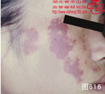血管瘤病理图片图601-图620(图11)