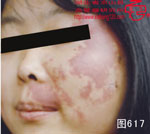 血管瘤病理图片图601-图620(图16)