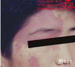 血管瘤病理图片图601-图620(图17)
