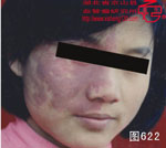 血管瘤病理图片图621-图640(图1)