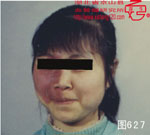 血管瘤病理图片图621-图640(图6)