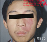 血管瘤病理图片图621-图640(图9)