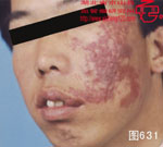 血管瘤病理图片图621-图640(图10)