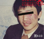 血管瘤病理图片图621-图640(图12)