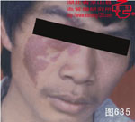 血管瘤病理图片图621-图640(图14)