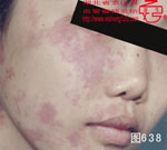 血管瘤病理图片图621-图640(图17)