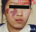 血管瘤病理图片图621-图640(图18)