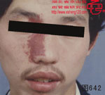 血管瘤病理图片图641-图660(图1)