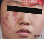 血管瘤病理图片图641-图660(图3)