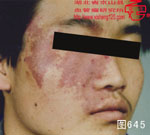 血管瘤病理图片图641-图660(图2)