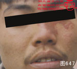 血管瘤病理图片图641-图660(图6)