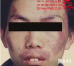 血管瘤病理图片图641-图660(图7)