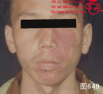 血管瘤病理图片图641-图660(图8)